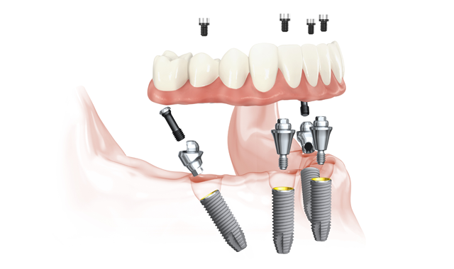 Преимущества установки зубных имплантов Nobel